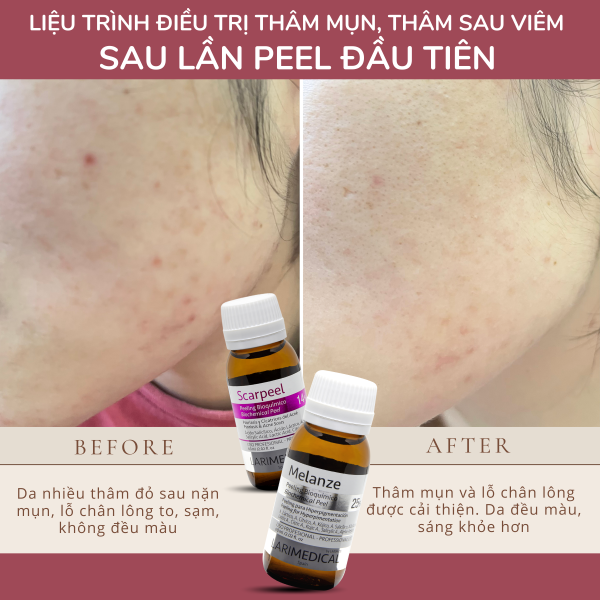 PEEL ĐIỀU TRỊ THÂM SAU VIÊM, SẸO DO MỤN - Larimedical