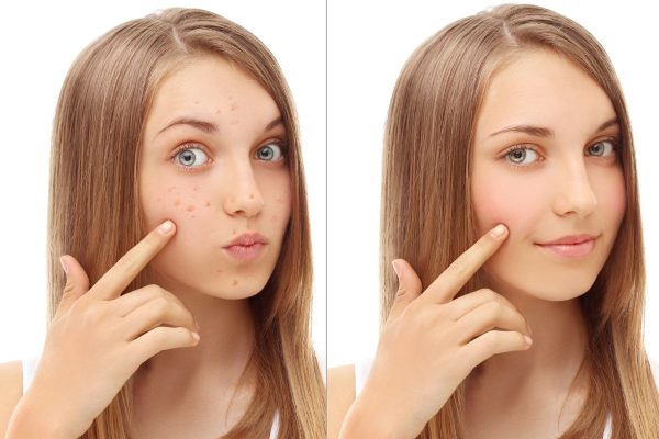 Tác dụng của peel da trị mụn - Peel da mụn là gì? 