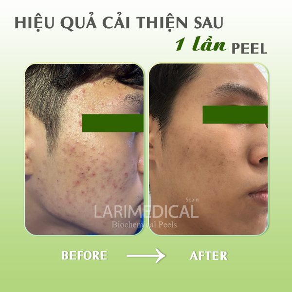 sản phẩm peel trị mụn - Comedopeel