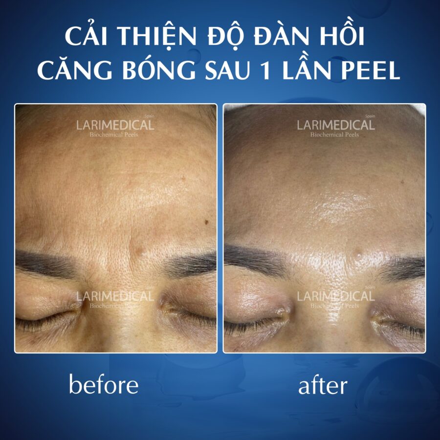 Peel căng bóng, trắng sáng - Larimedical